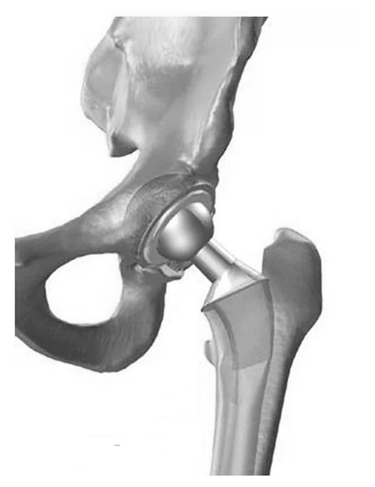 Операция тазобедренный кость. Перелом шейки бедра эндопротезирование. Эндопротезирование головки бедренной кости. Эндопротез шейки бедра. Гемиартропластика тазобедренного сустава.
